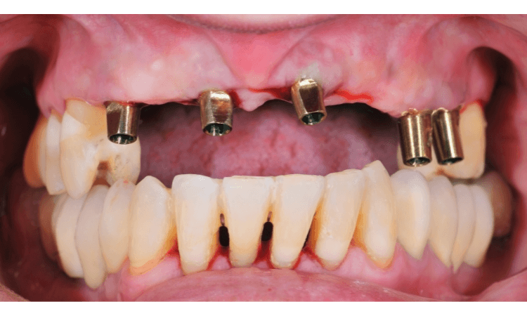 why teeth replacement is worthful