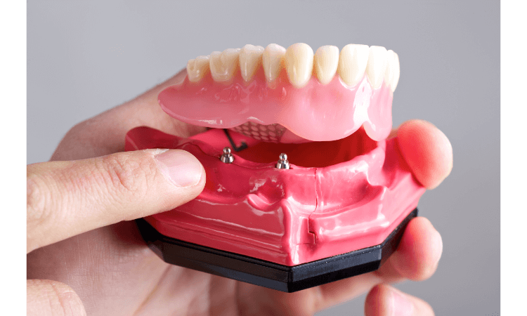 why teeth replacement is worthful