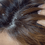 exfoliating scalp