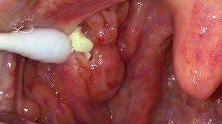 how to get rid of tonsil stones