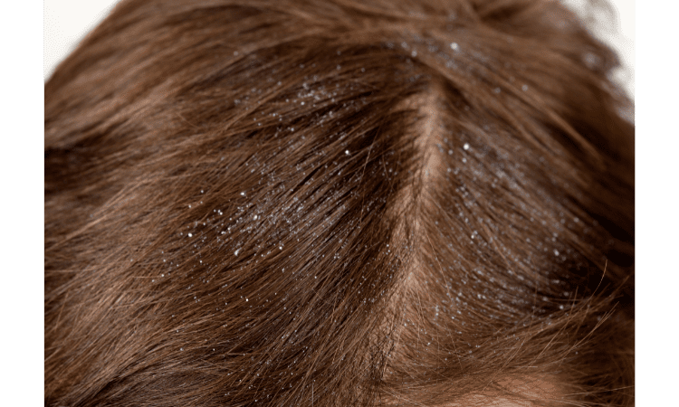 Rosehip Oil Benefits to Prevent Hair Loss