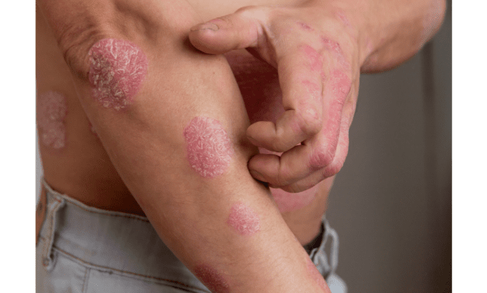 What is psoriasis and how can it be treated