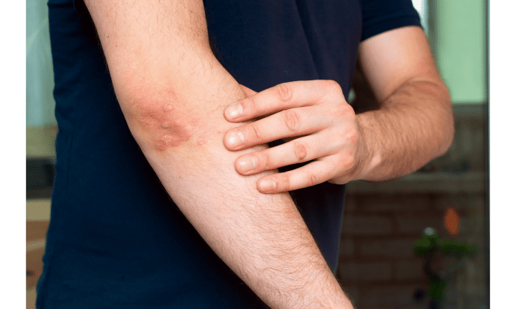 What is psoriasis