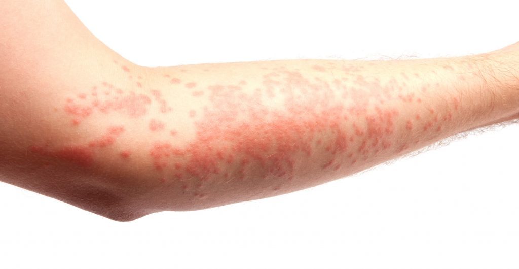 Can skin blanching help diagnose rash severity