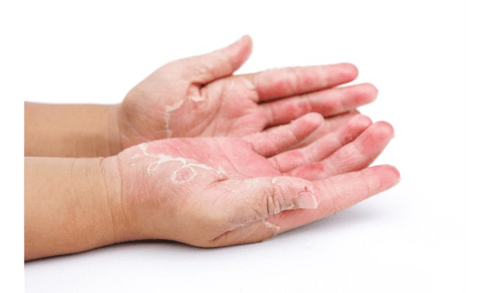 How Laundry Detergent Can Cause Contact Dermatitis