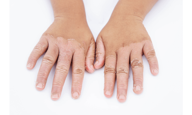How Laundry Detergent Can Cause Contact Dermatitis
