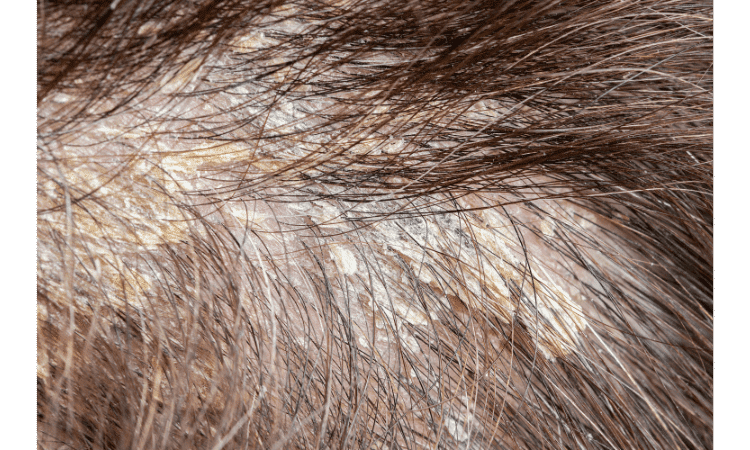 Hair loss from hard water in your shower