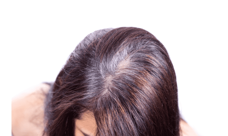 Hair loss from hard water in your shower
