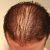 What Is Diffuse Hair Loss? An In-depth Exploration