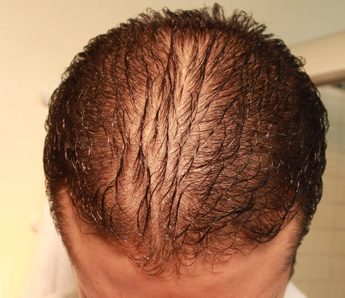 What Is Diffuse Hair Loss? An In-depth Exploration