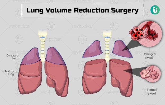 How to Improve Lung Health: A Comprehensive Guide