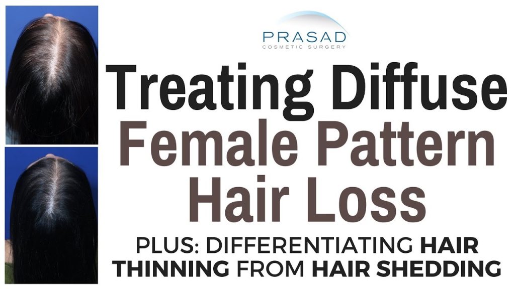 What Is Diffuse Hair Loss? An In-depth Exploration