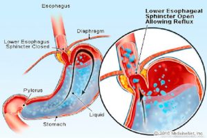 مرۍ ته د معدې تېزاب راپورته کېدل  Gastro-esophageal Reflux
