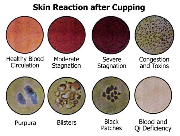 Cupping Massage Therapie reactions
