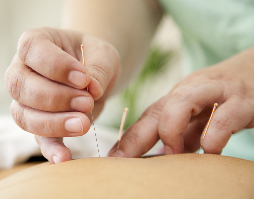 Akupunktur - Aku-Zone - Smertelindring - Behandling i Herning