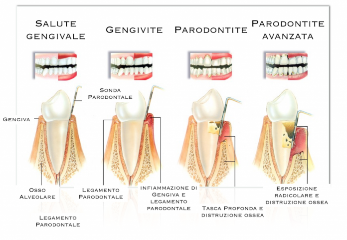 stato gengivale tabella