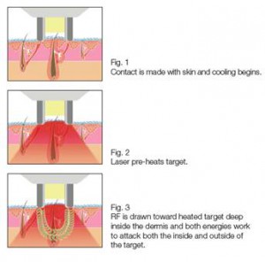 brazilian laser hair removal