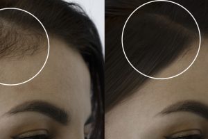 woman head baldness before and after treatment