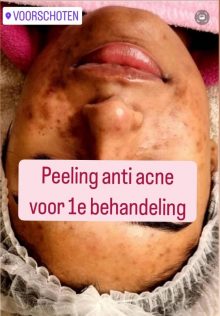 acne peeling stap 1