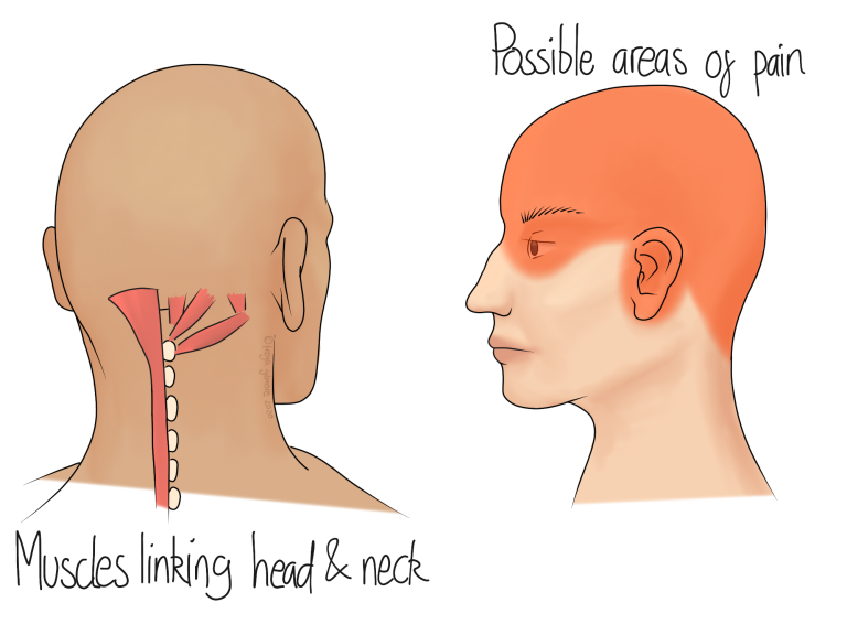 Read more about the article Headaches Coming From the Neck