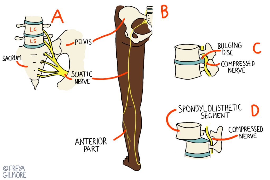 Sports Injuries: Sciatica