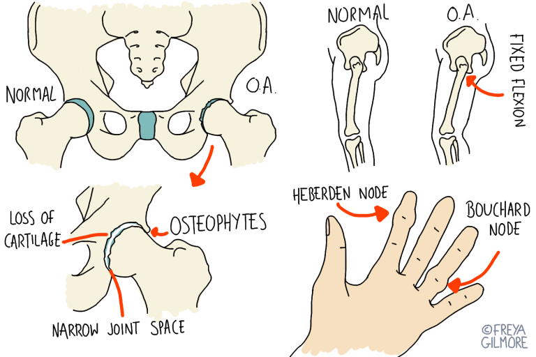 Read more about the article Osteoarthritis in the Hip and Knee