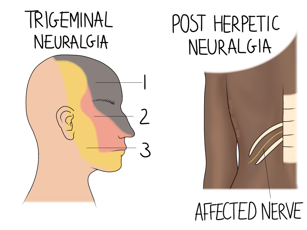 Trigeminal neuralgia and post herpetic neuralgia