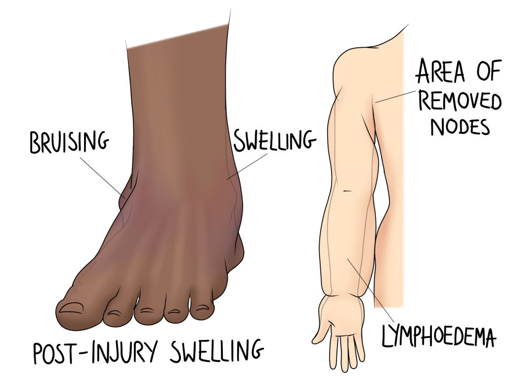 Swelling in an ankle sprain and lymphoedema