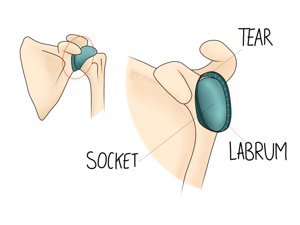 Shoulder labrum