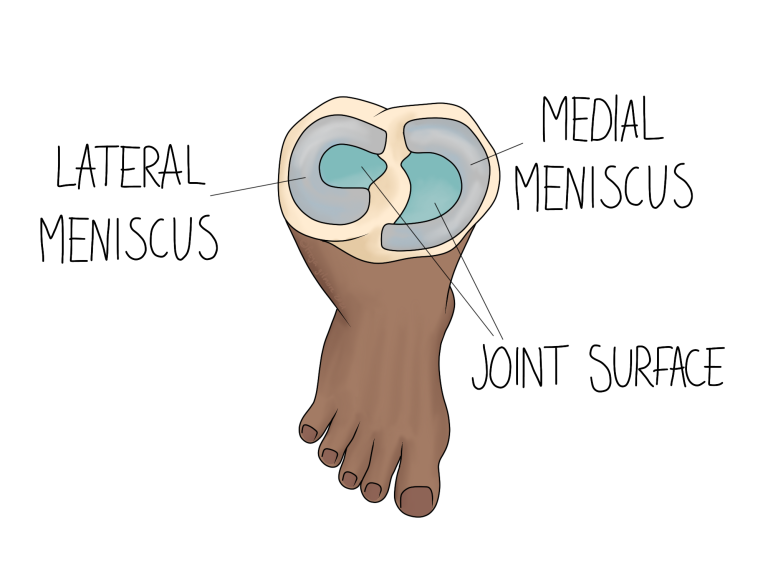 Read more about the article Meniscus Tears