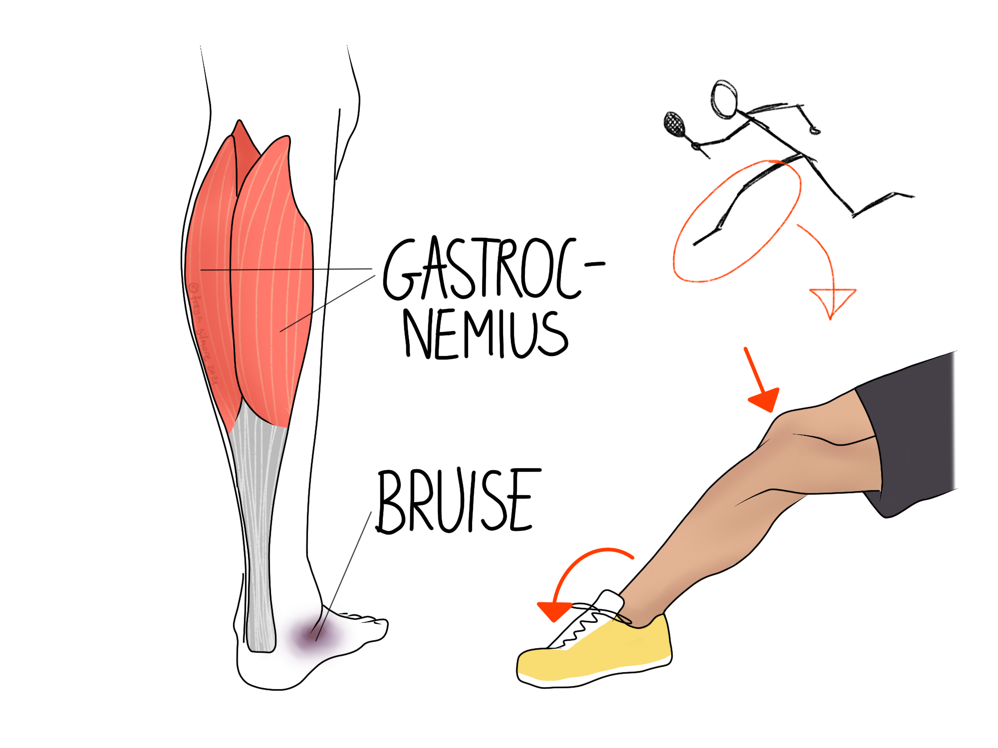 Read more about the article Tennis Leg