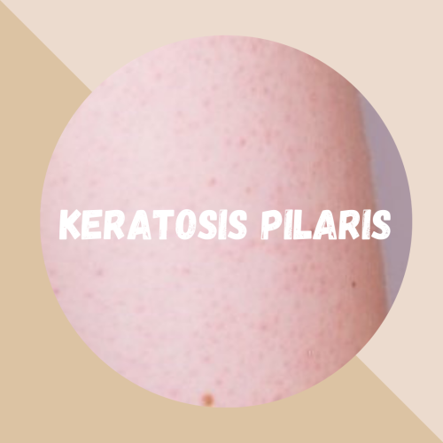 Keratosis Pilaris – Vad är det och hur kan du arbeta med det?