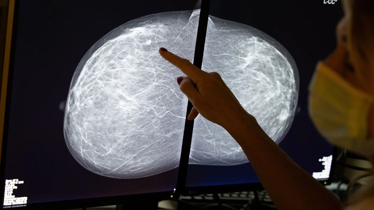 Cancer du sein : la réforme qui divise