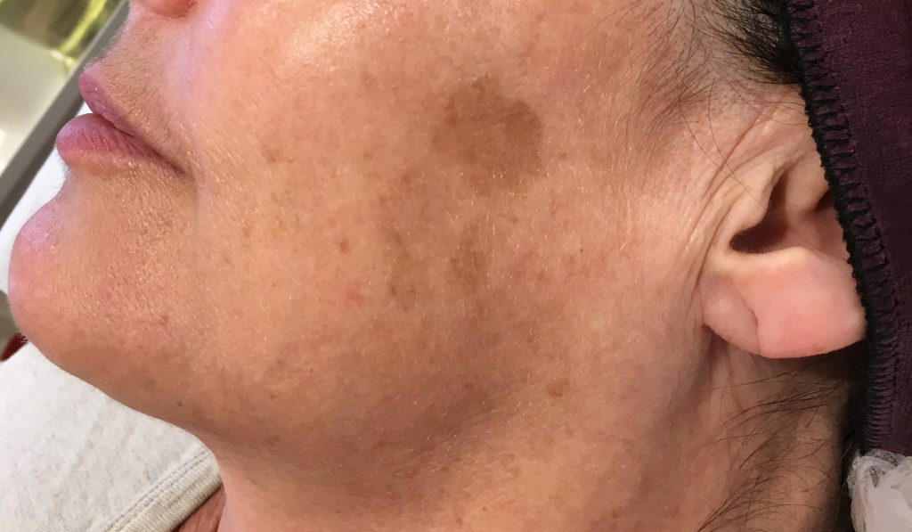 Photograph of sun damage on woman's cheek before treatment