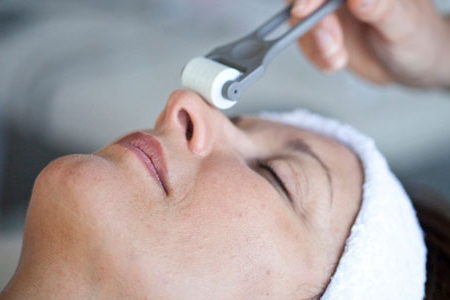 Woman receiving micro-needling roller treatment as part of collagen stimulation therapy.