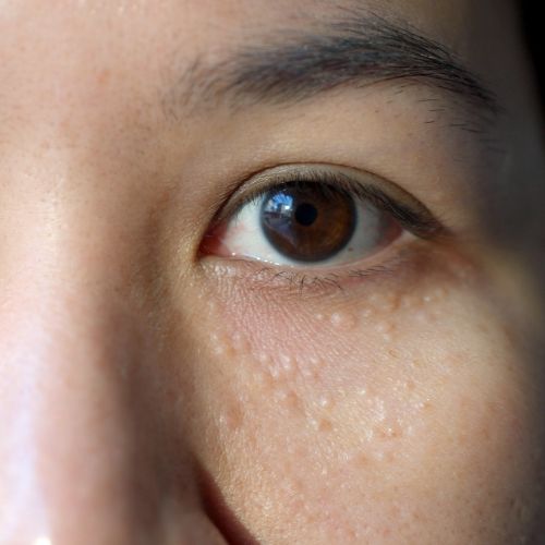 Milia removal treatment