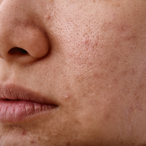 Sebaceous Hyperplasia Sebaceous Hyperplasia Removal Treatment