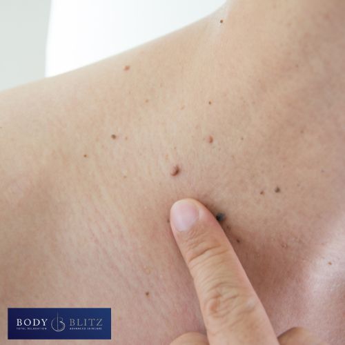 Wart Removal Clinc - Bucks Wart removal treatment