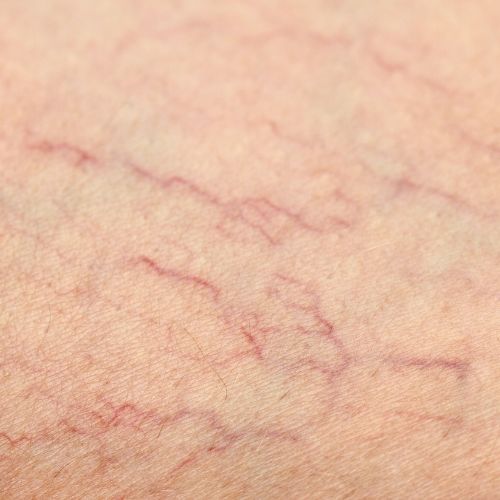 Thread Vein Removal Thread Vein Removal