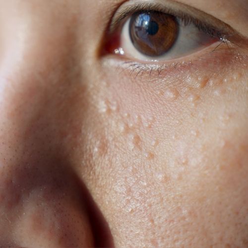 Syringomas Syringomas removal treatment