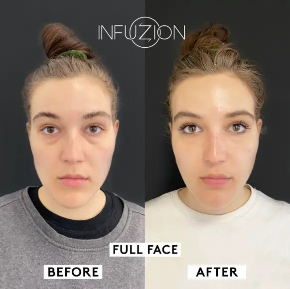 Infuzion