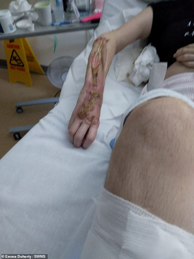 Emma took pictures of her hand after she contracted necrotising fasciitis
