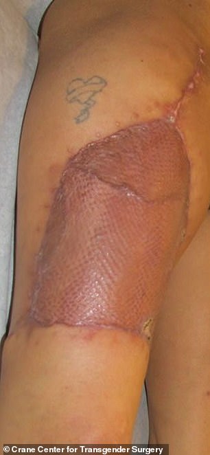Another is anterolateral thigh flap, where skin is taken from the thigh (pictured one-month post-op)