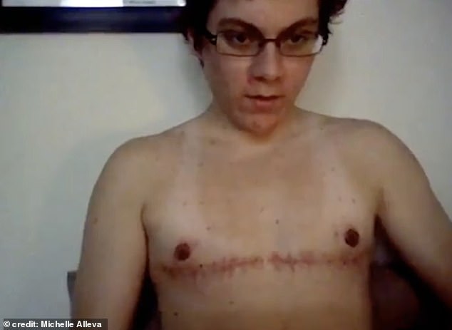 Michelle went back-and-forth with mental health issues - in which a number of diagnoses were made but her gender dysphoria left unexplored. She's pictured here after her mastectomy