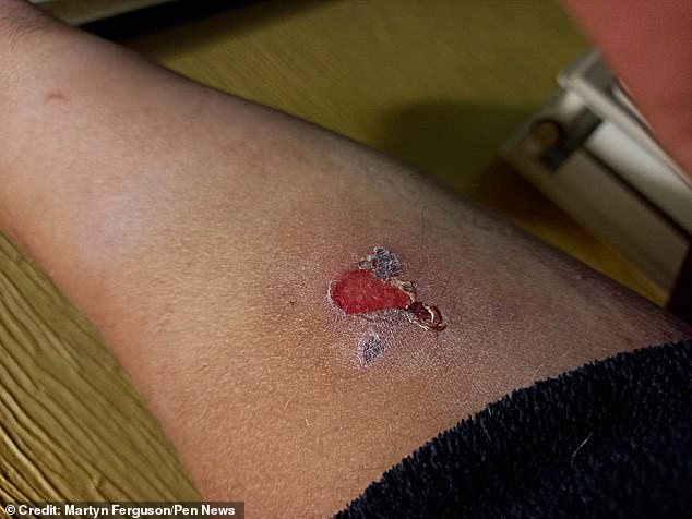 Mr Ferguson said: 'I was unaware I'd managed to get sap on my arm – it reacts to sunlight and it was several hours before I started to experience symptoms'