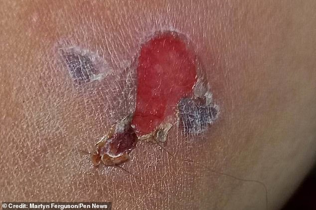 Now the 57-year-old is warning others to beware of the hated plant. He said: 'My injury was mild in comparison – it took a while to heal, it was hot, painful and incredibly itchy'