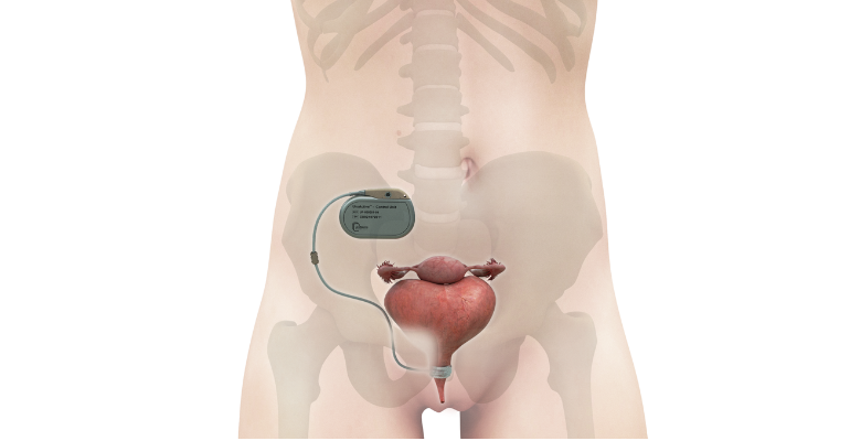 UroActive automated artificial sphincter system designed to treat stress urinary incontinence. Diagram shows the device impanted in a female anatomy..png UroActive automated artificial sphincter system designed to treat stress urinary incontinence. Diagram shows the device impanted in a female anatomy..png