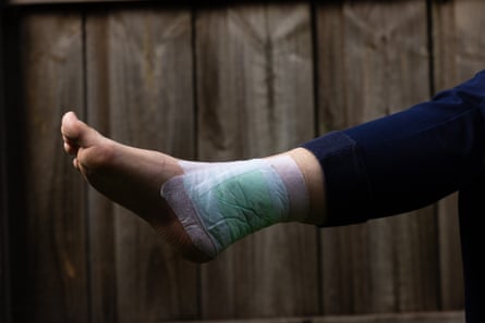 A photo of a bandaged ankle