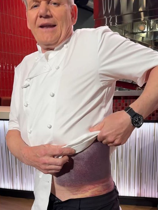 The celebrity chef showed his injuries