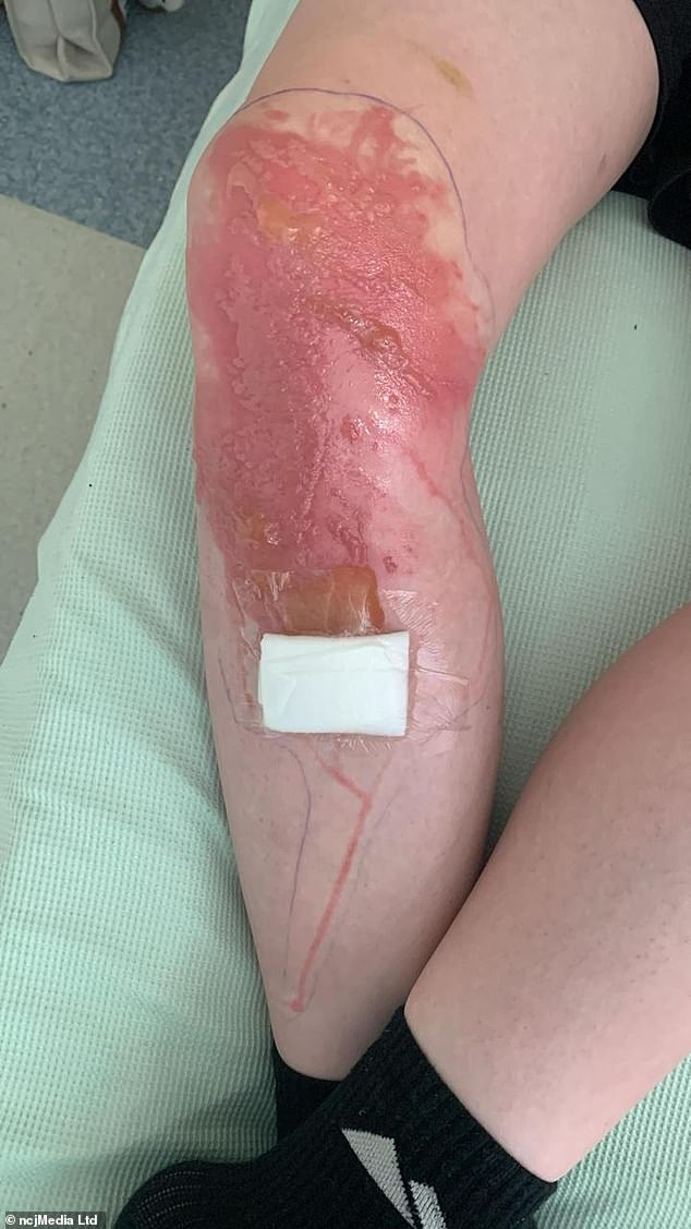 Michael, 13, has been told to stay clear of the sun for a whole year to allow his wounds to heal